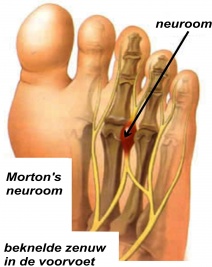 Mortons neuroom